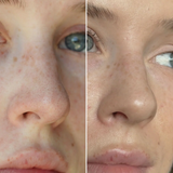 PATCHS NEZ PURIFIANT